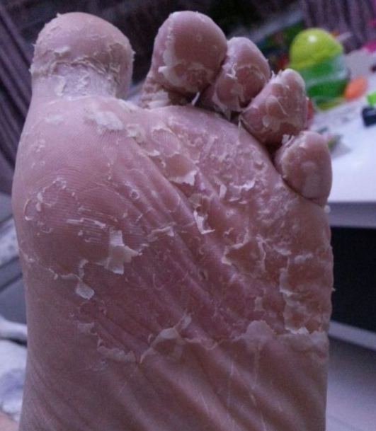 脚气有水泡脱皮怎么办