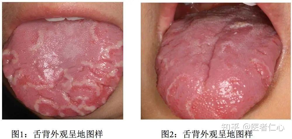 地图舌会引起哪些不良症状?