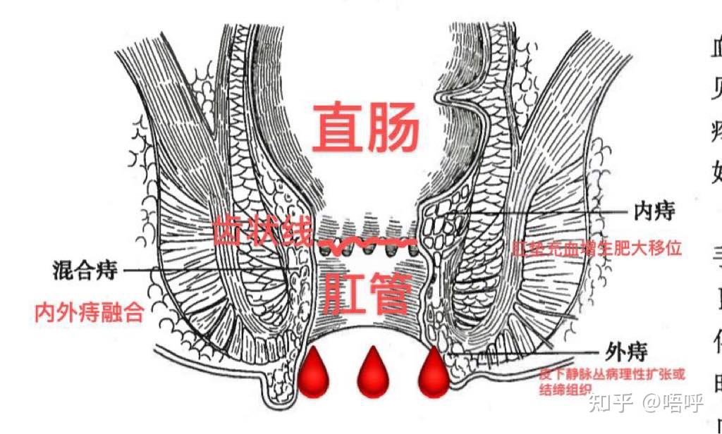 痔疮到底是个啥?有没有不用开刀就能去除的方法 - 知乎