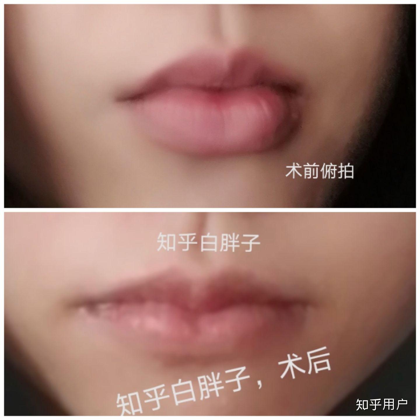 上海张玲医生唇部整形术改善唇形 - 知乎