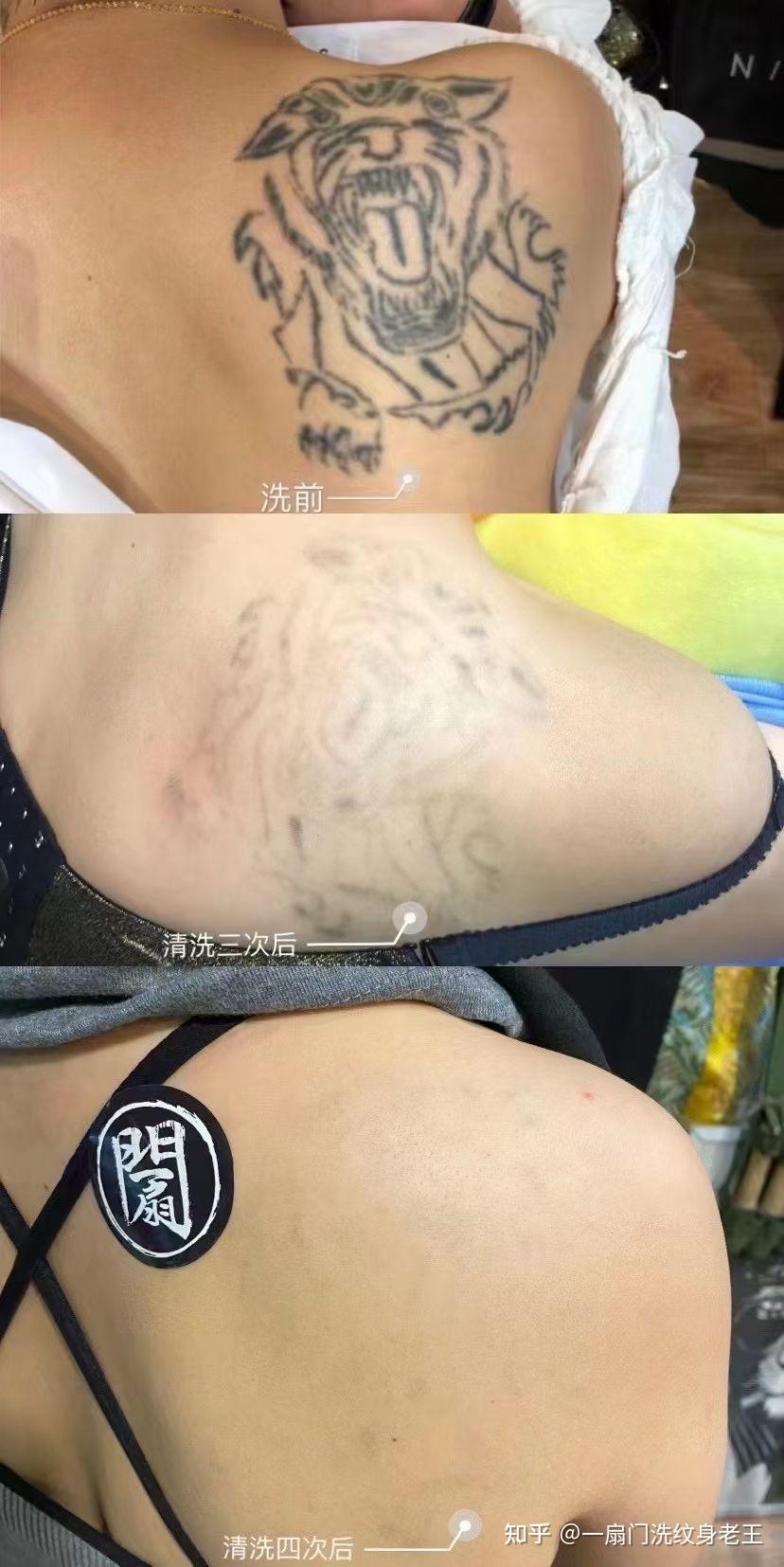 杭州洗纹身哪里好,无痛不留疤的那种? 