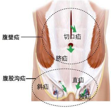微创技术治好了腹部大洞腹腔镜腹壁切口疝修补术