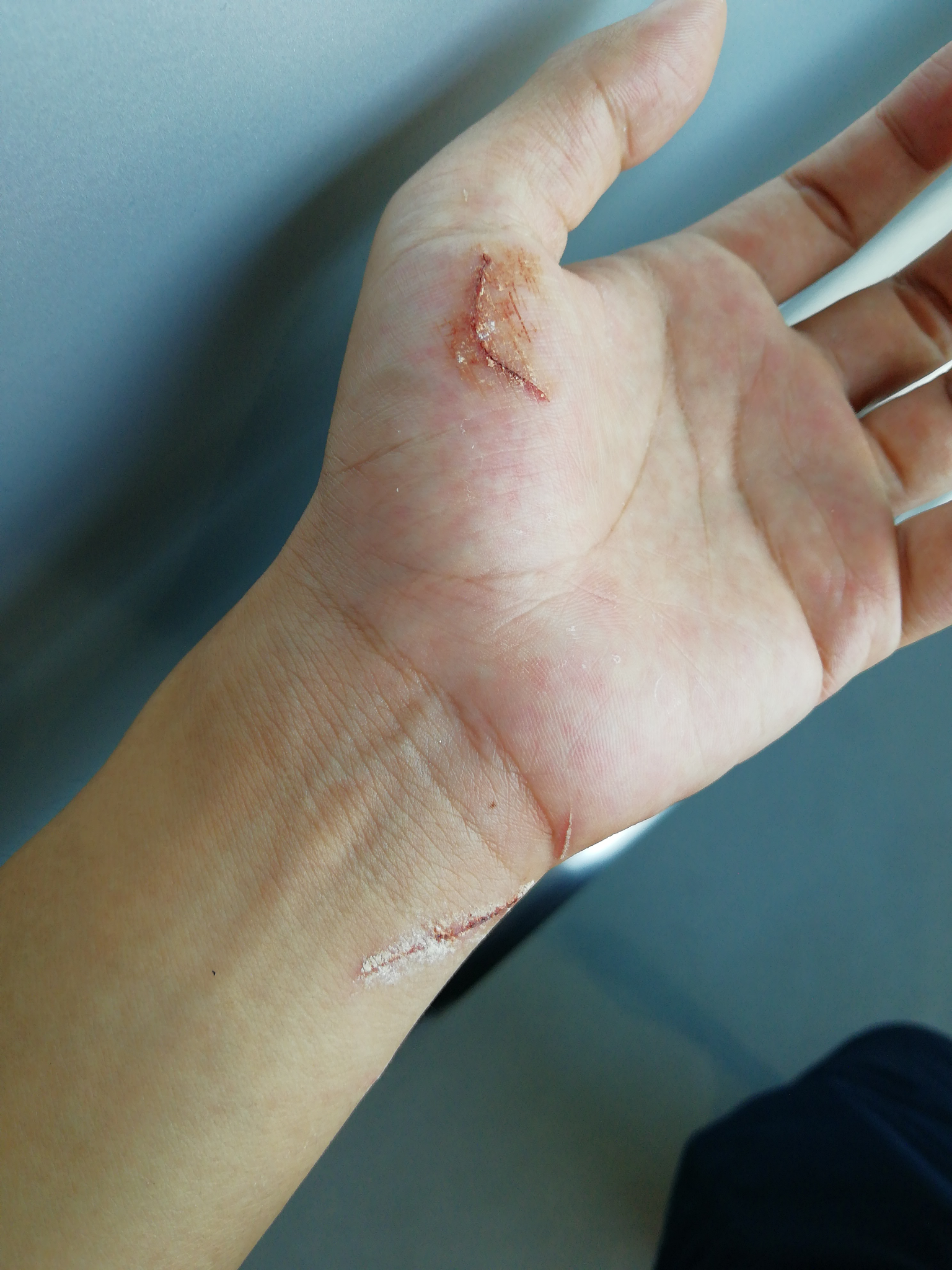 被猫抓出血了要打针吗