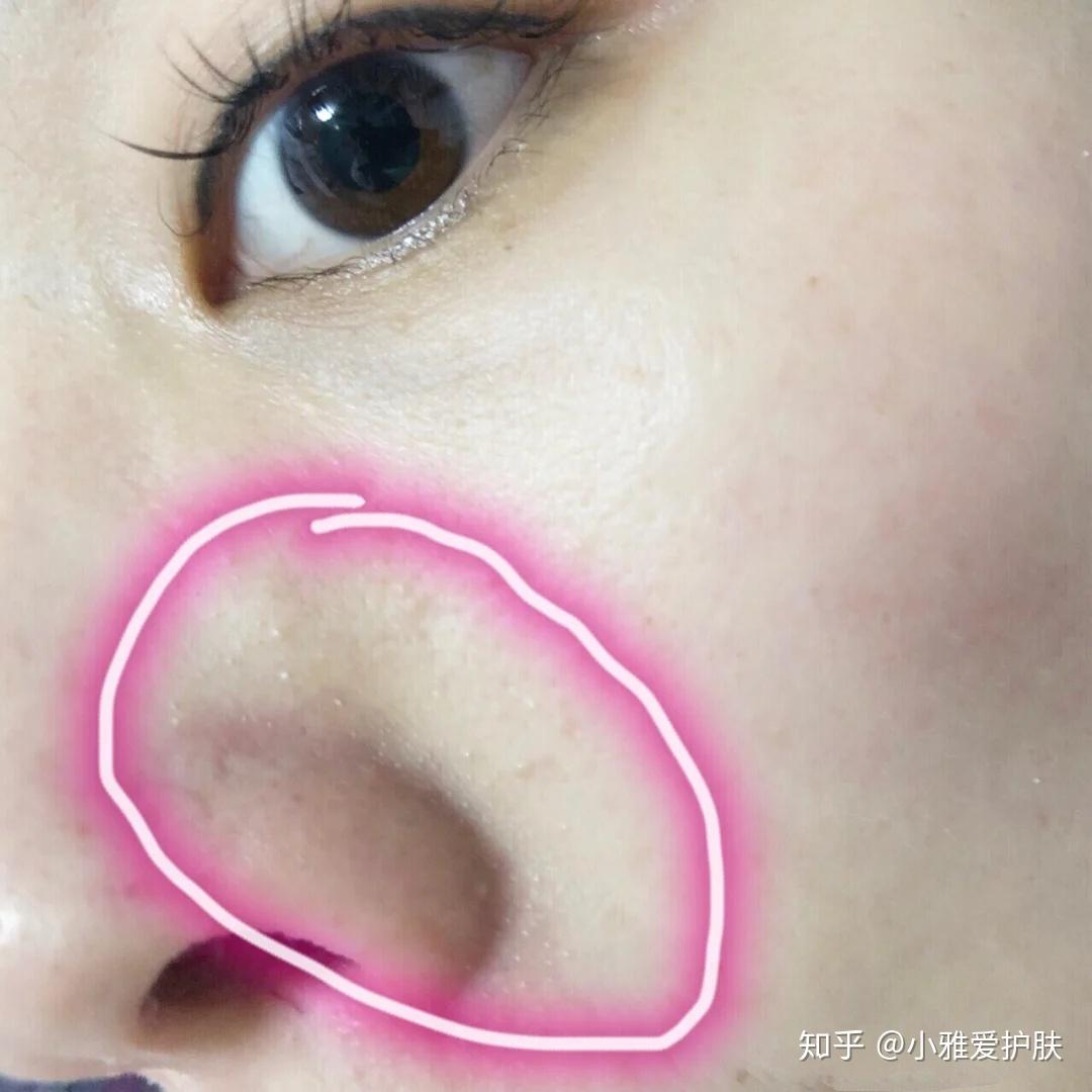 为什么每次洗完澡敷面膜后鼻头上都会有白头