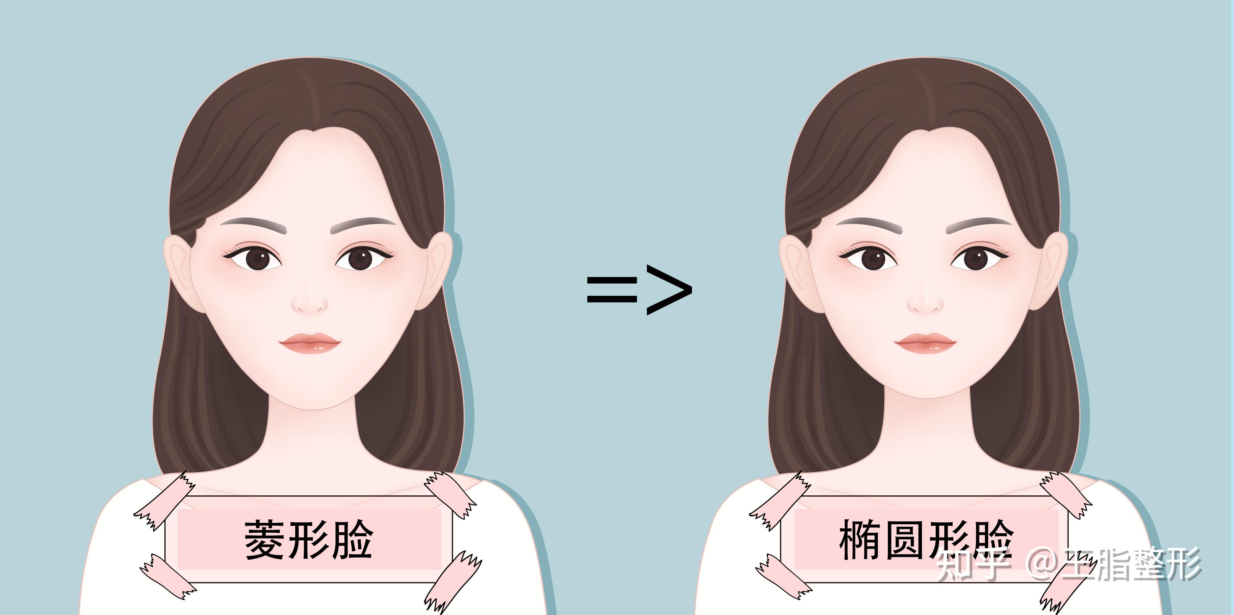 【王脂整形】王脂面雕改变脸型 - 知乎
