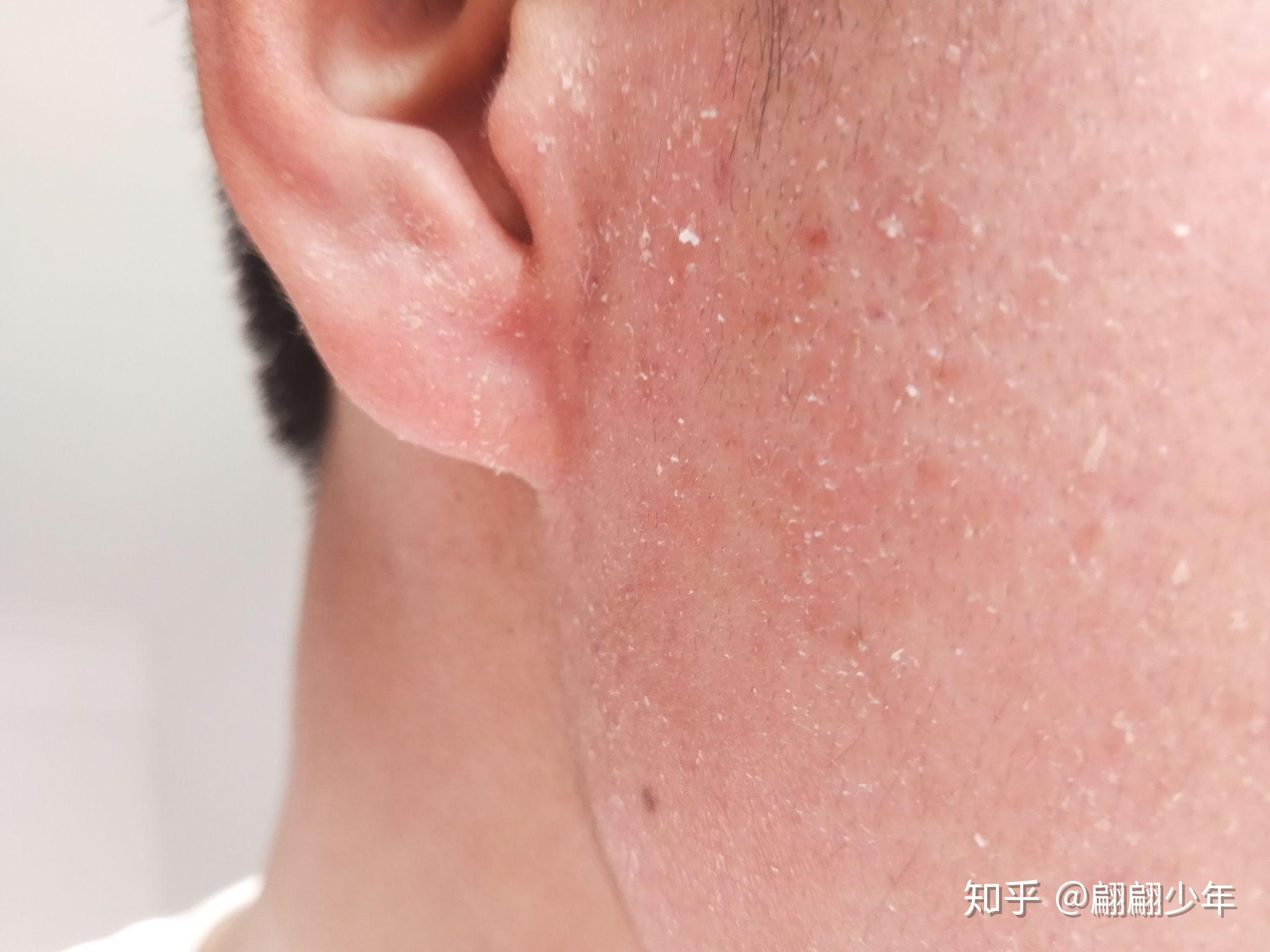 阿达帕林凝胶灼烧蜕皮? - 知乎