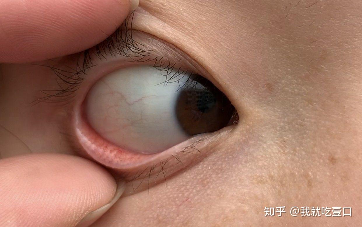 结膜血管明显怎么办