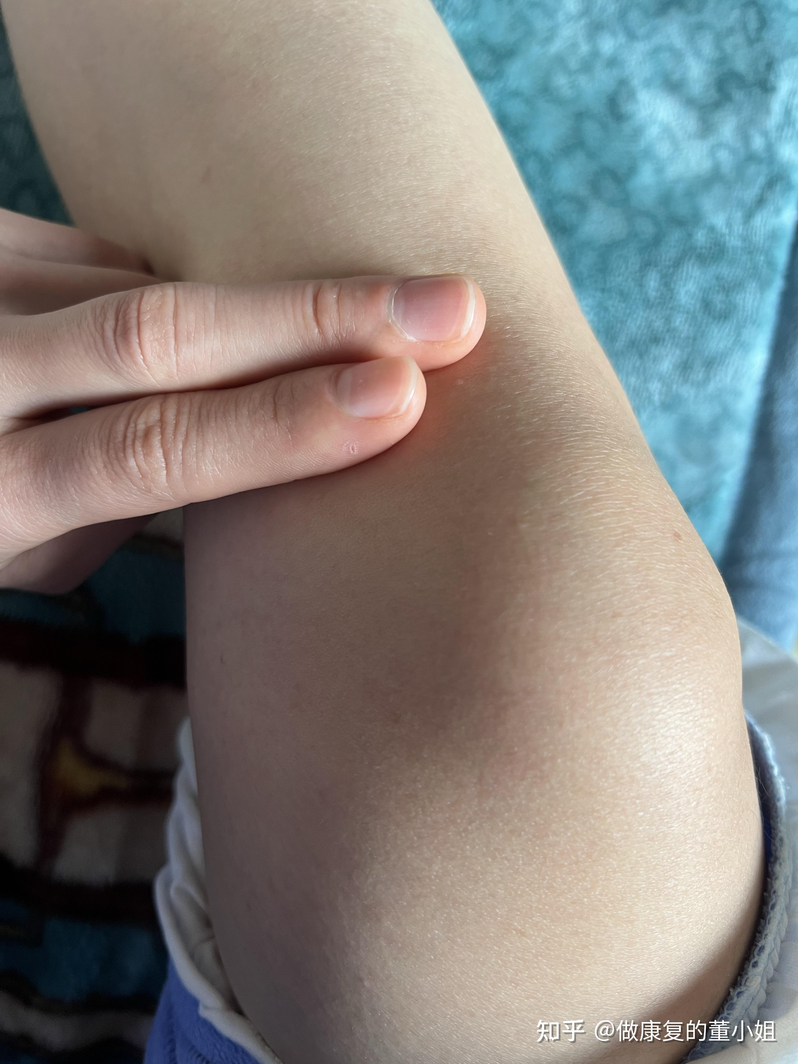 如何自行区分鹅足腱滑膜炎和半月板损伤? - 知乎