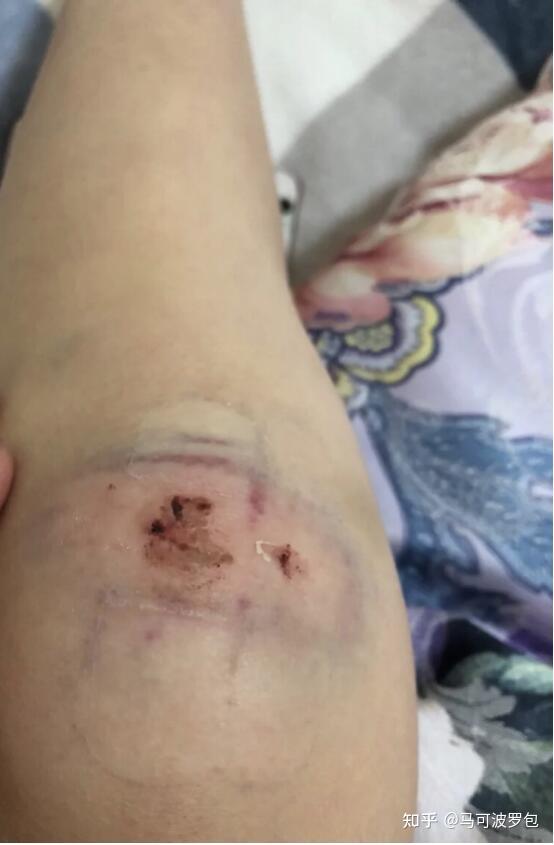 大腿上的冻疮疤痕怎么去除好? - 知乎