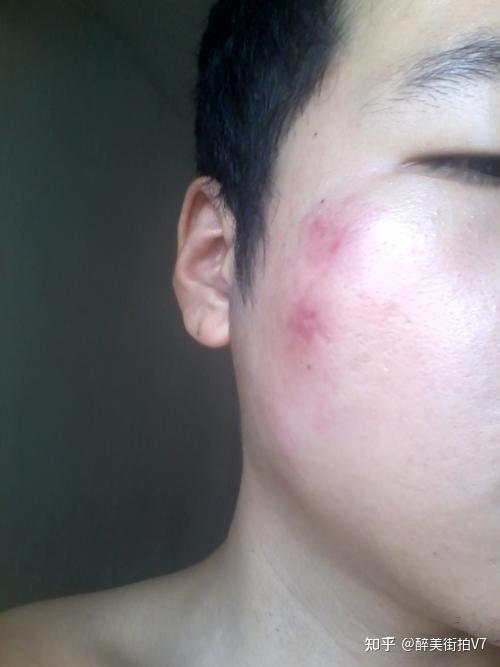 男生皮肤过敏该如何保养