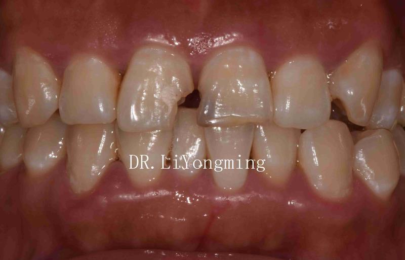 仅凭x片诊断继发龋可靠吗