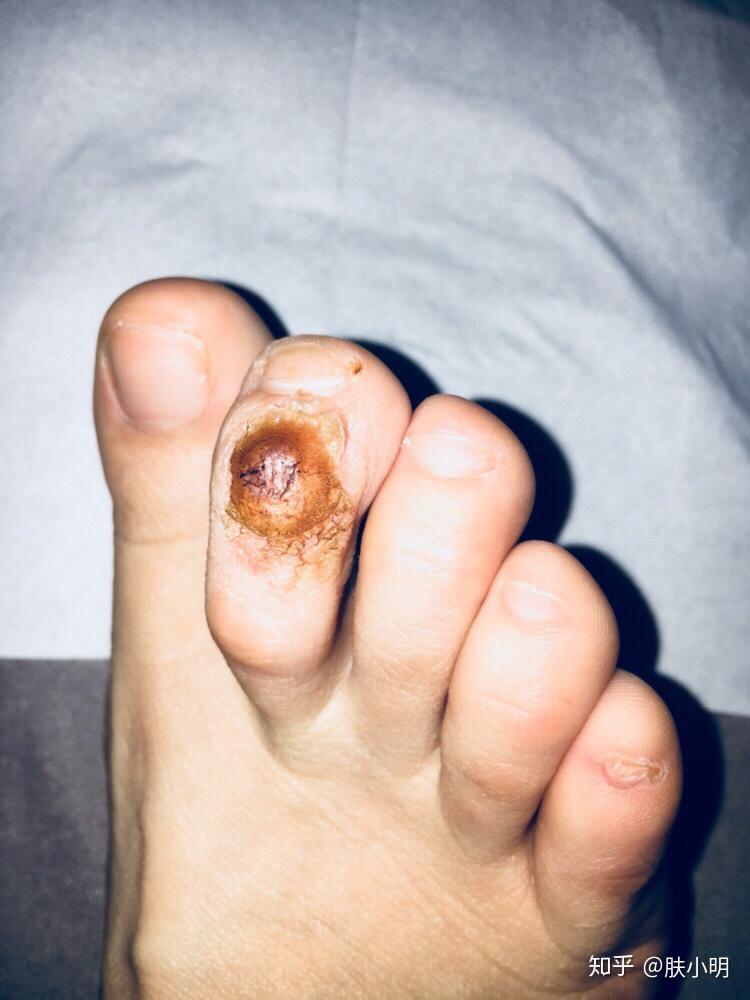 脚上被鞋子磨出茧要怎么办