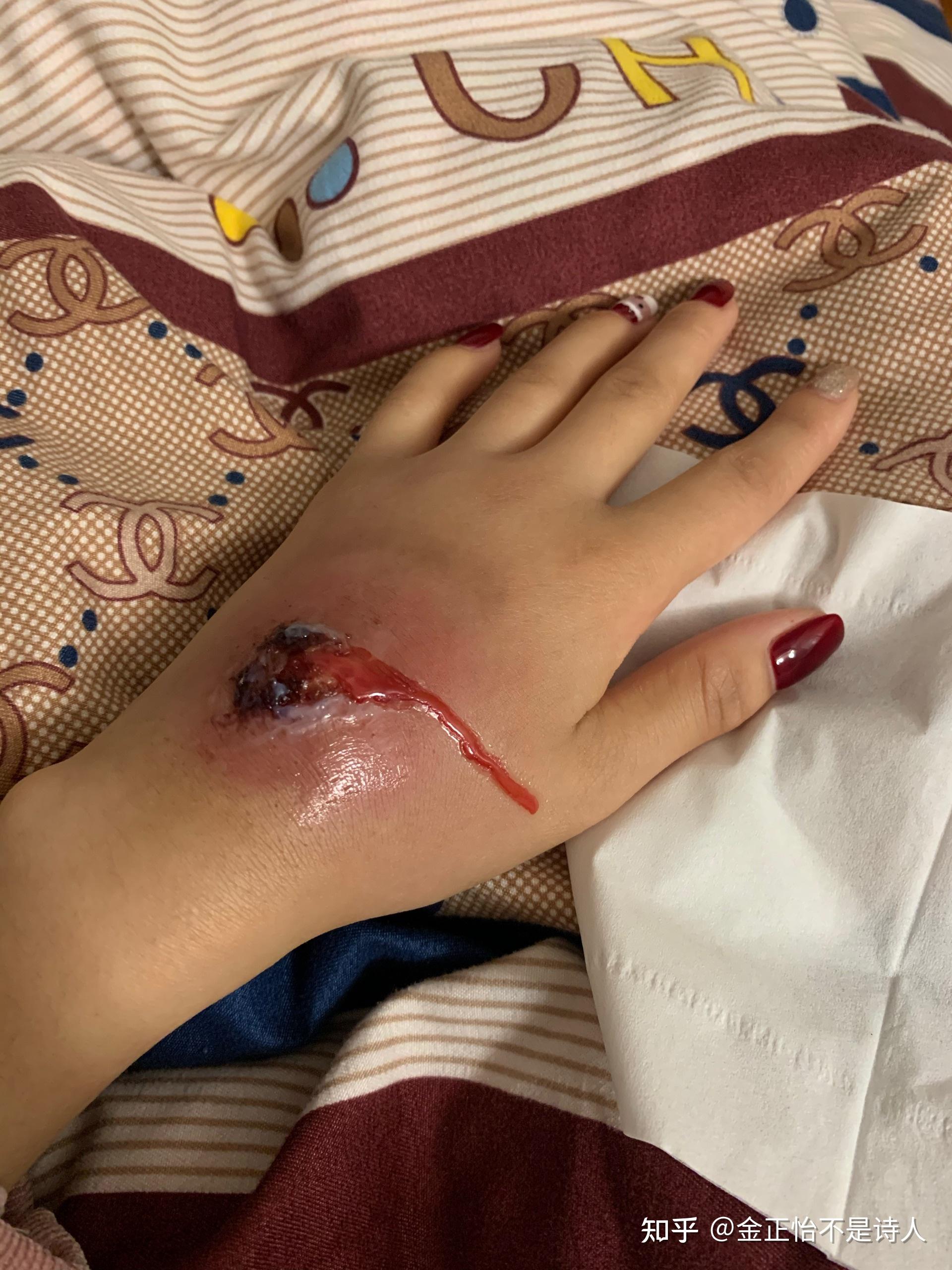 一个火疖子能大到什么地步? - 知乎