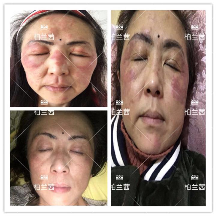 #从“毁容烂脸”到“整容修复”只差TA# - 知乎
