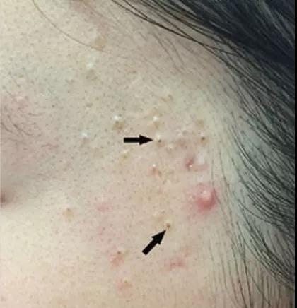 闭口痘痘怎么去除