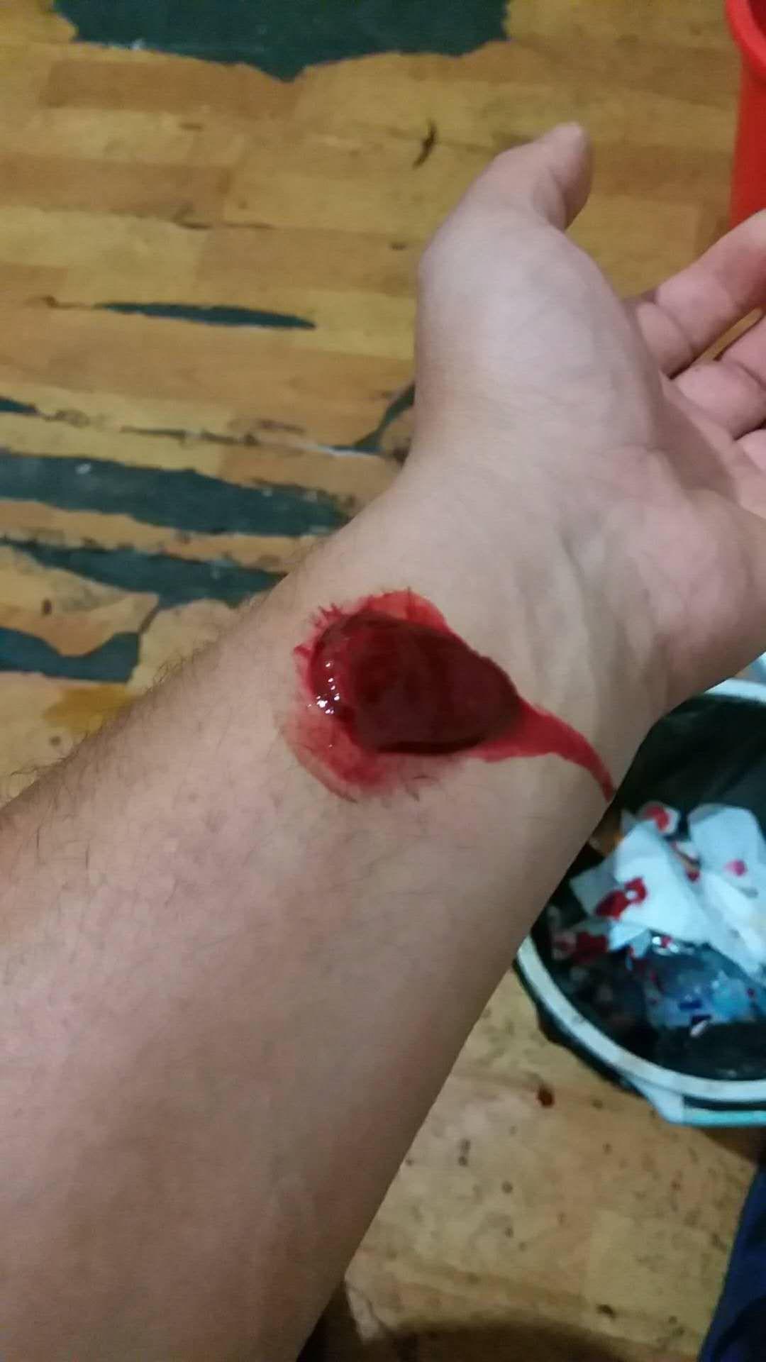 用梅花针拔气罐法从血液中出来的果冻状的东西是什么? - 知乎