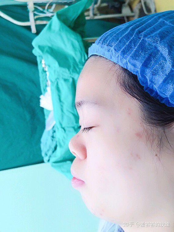 蒜头鼻怎样改善