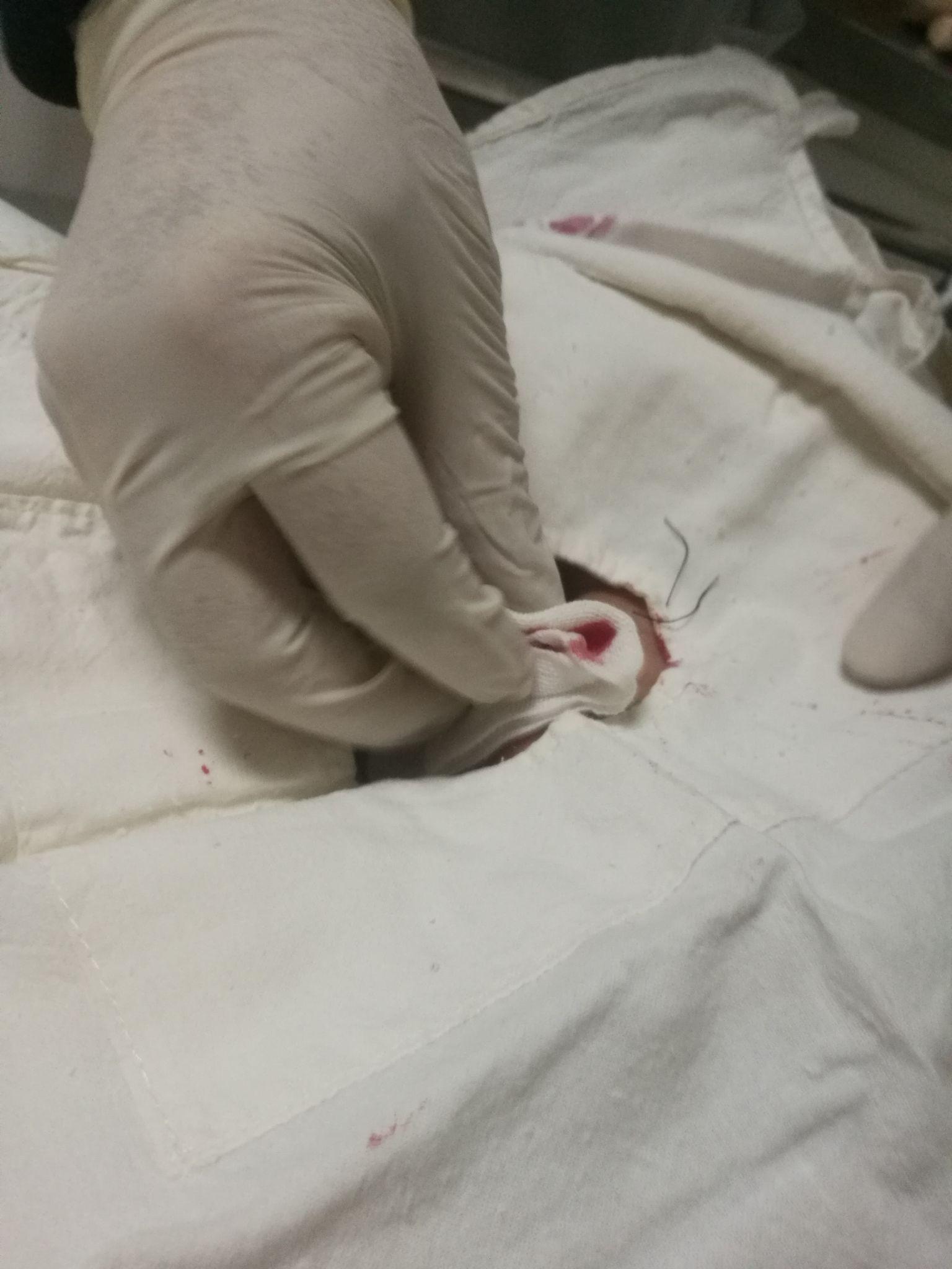 在医院经历缝针是怎样的一种体验