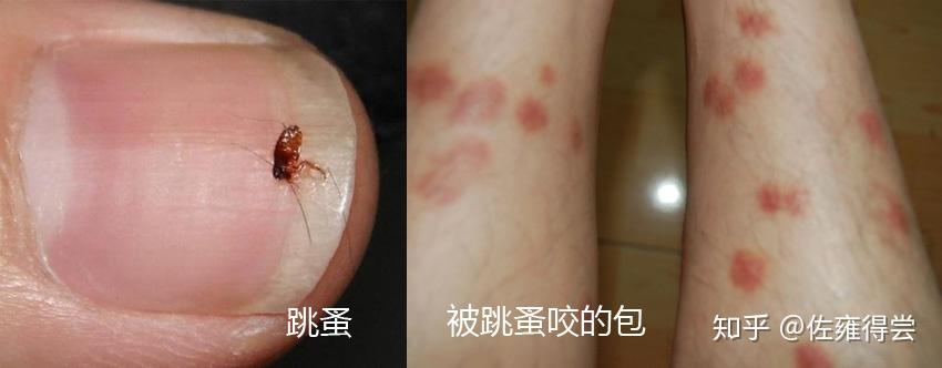 身上长跳蚤是什么感觉?