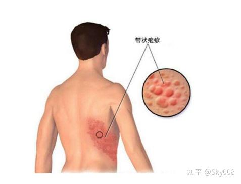 走近医学之带状疱疹上中医是如何认识带状疱疹的