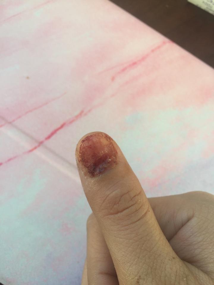 指甲被连根拔起是什么体验