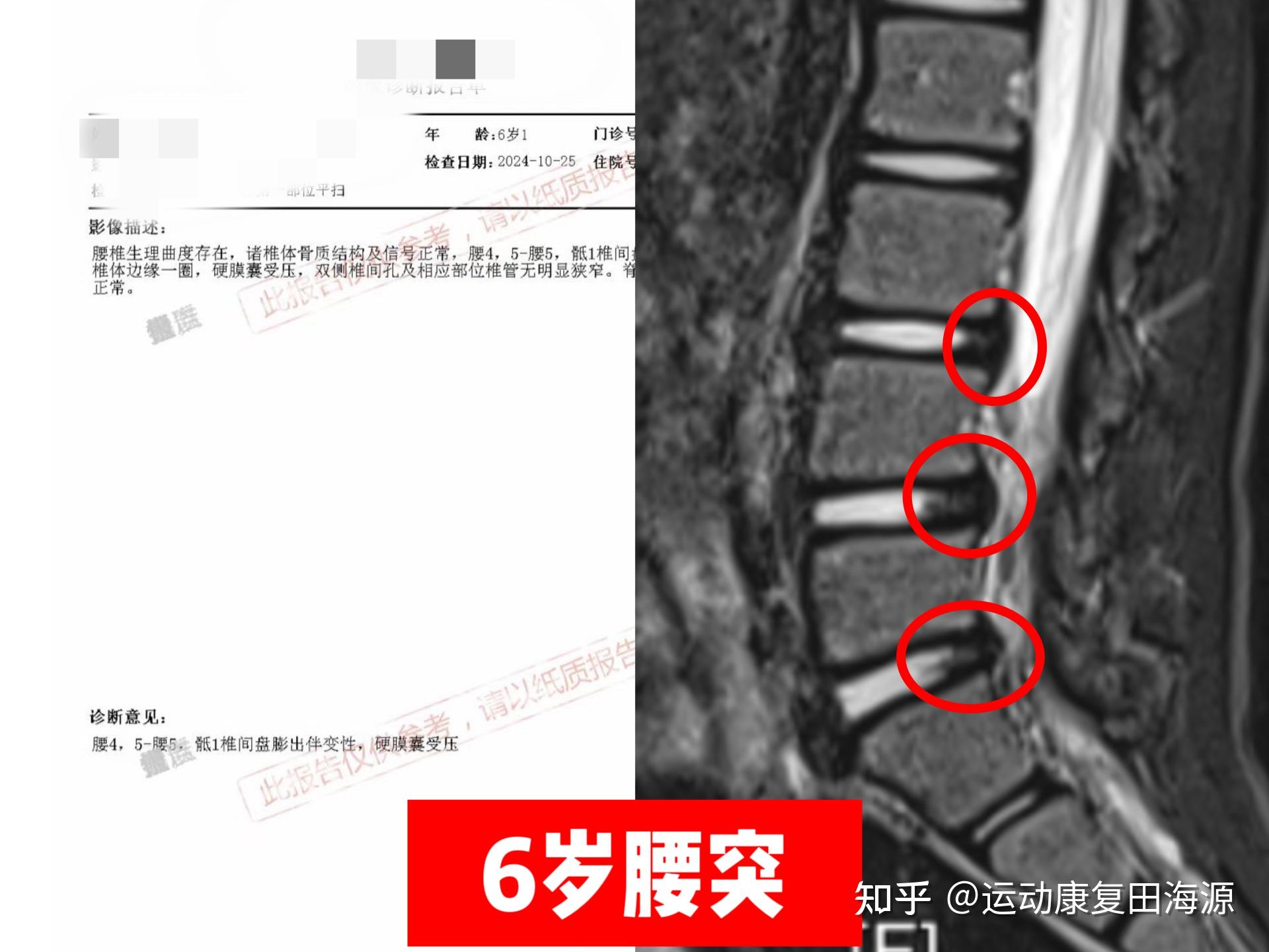 脊柱关节突交锁图片