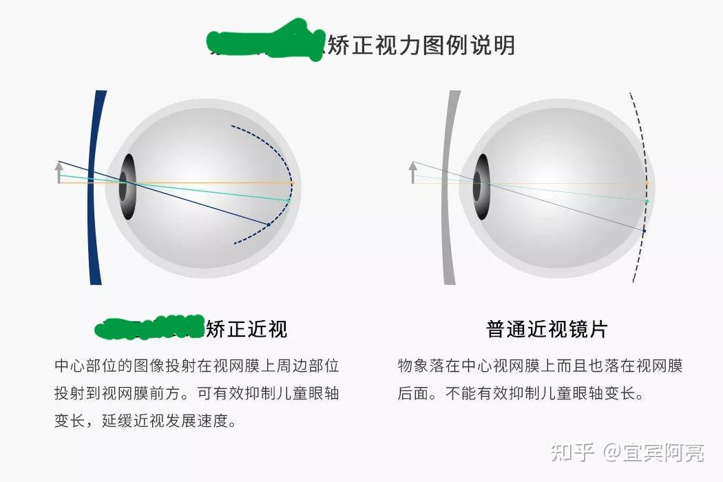 新一代多点复合离焦,伟星星乐视,也是不错的选择。 - 知乎
