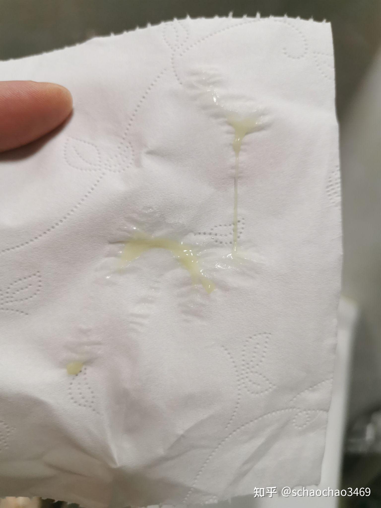 每天内裤上都有白带,脓性的,偶尔会痒,之前去过各种公立三甲医院但都