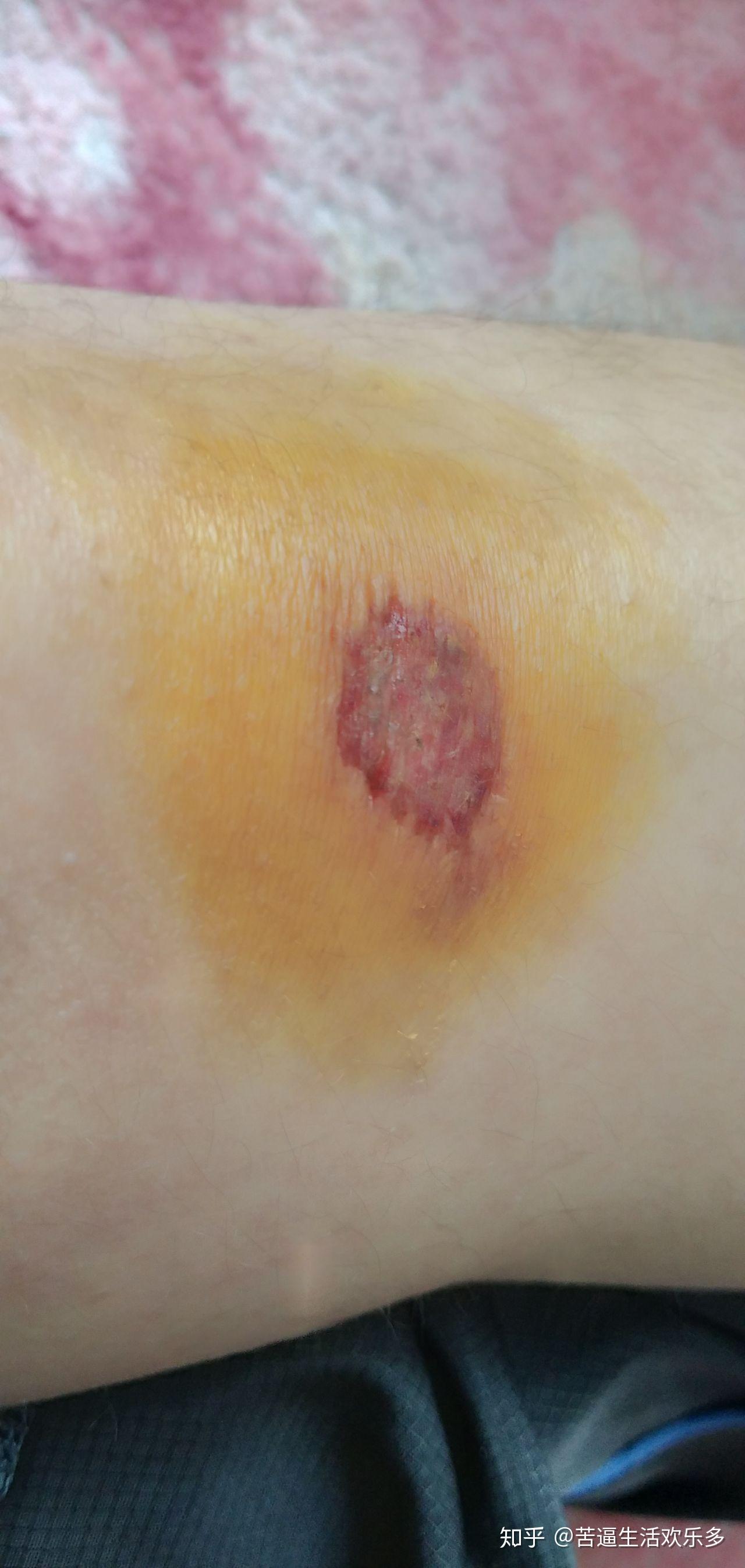 如何在膝盖擦伤不能碰水的情况下洗澡