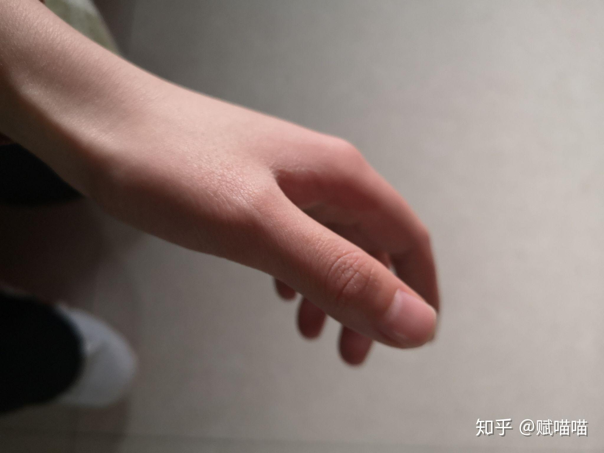 右手大拇指根部靠虎口处骨头稍微凸起是怎么回事需要去医院吗