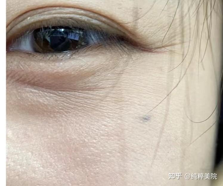 脸上有皱纹细纹的那种做什么医美好?