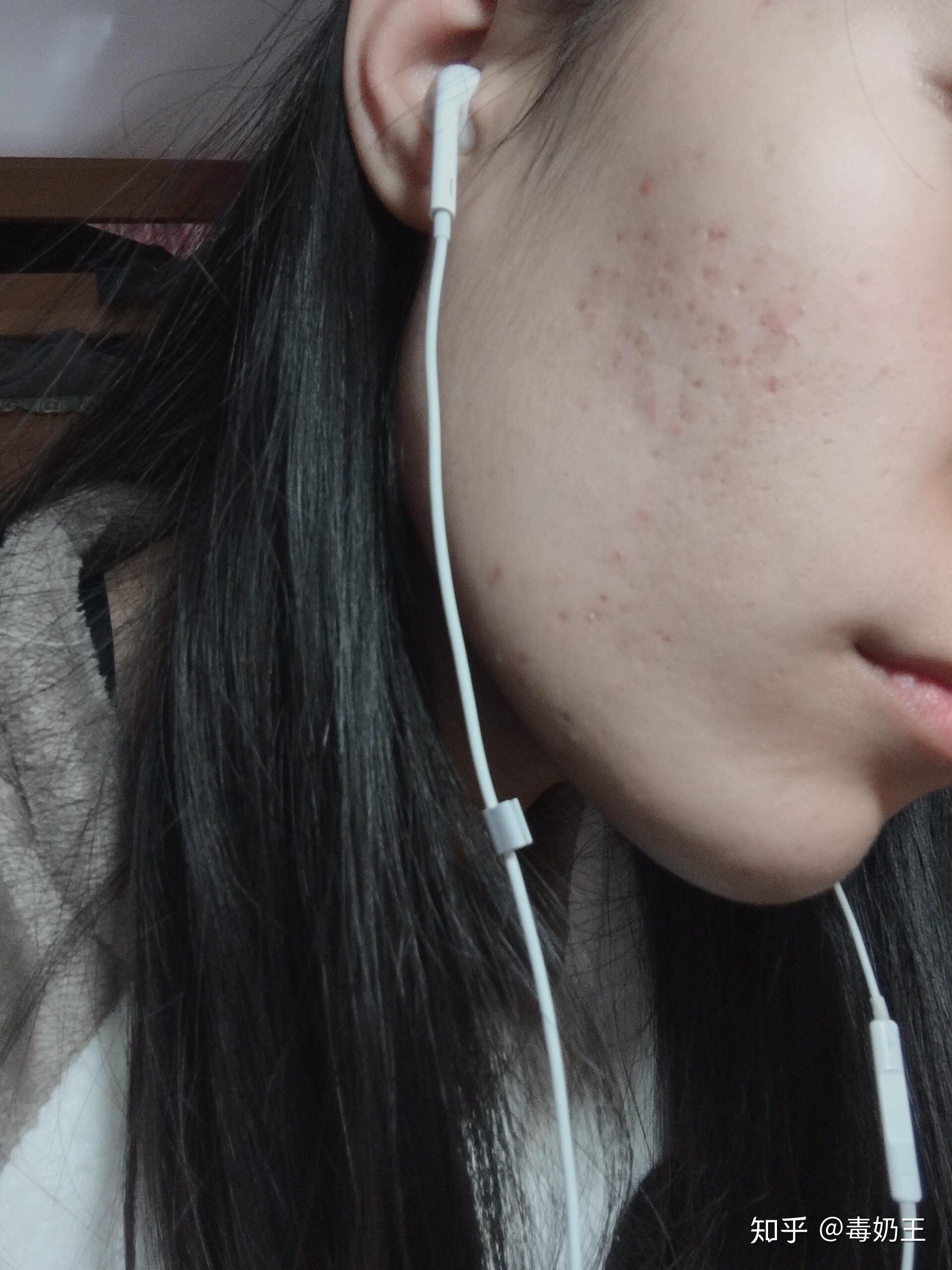 怎么祛除痘印痘坑