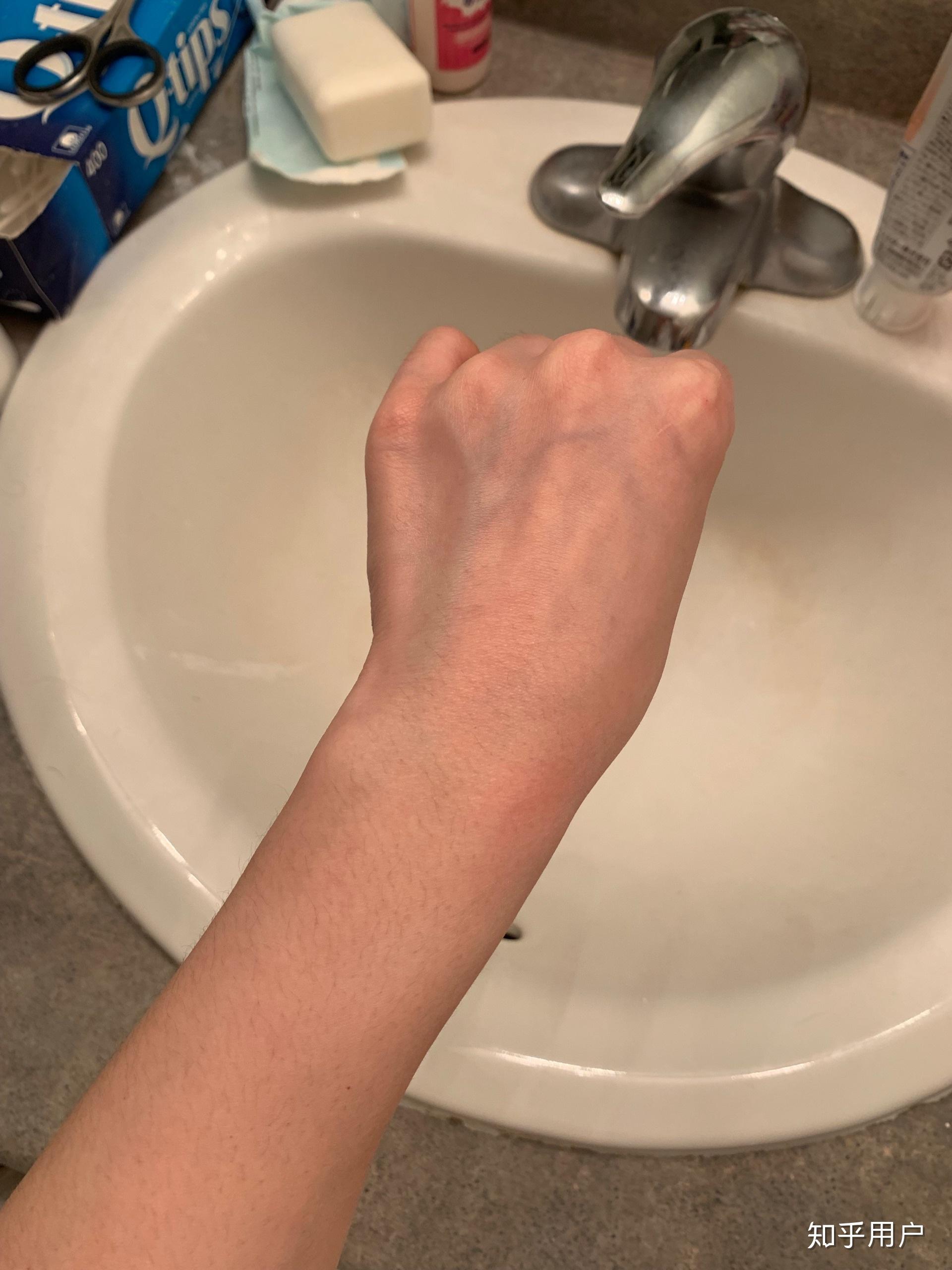 为什么我的手背上静脉血管那么明显?如何改善? - 知乎