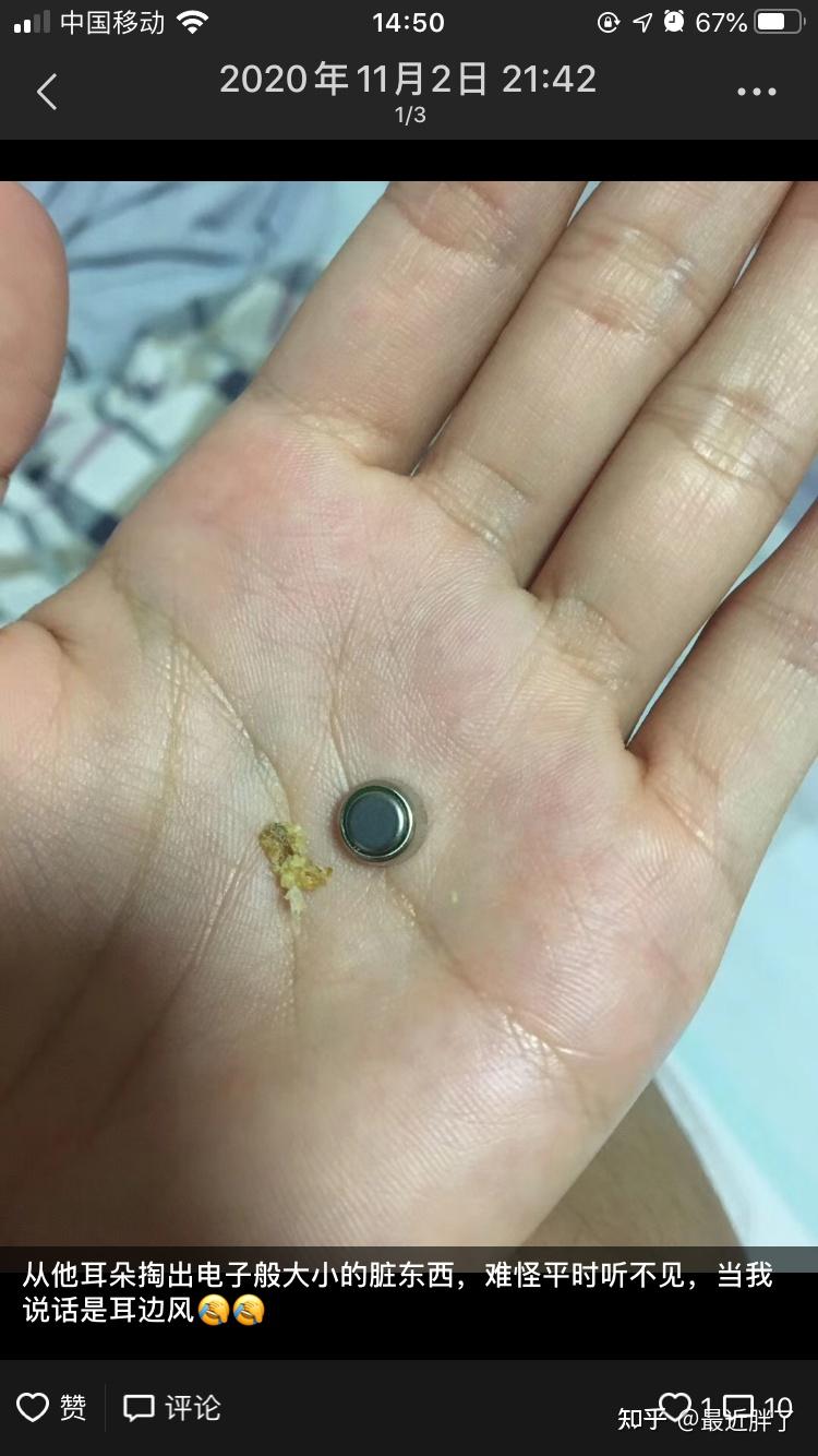 3岁女宝耳朵的耳屎堵住怎样清理