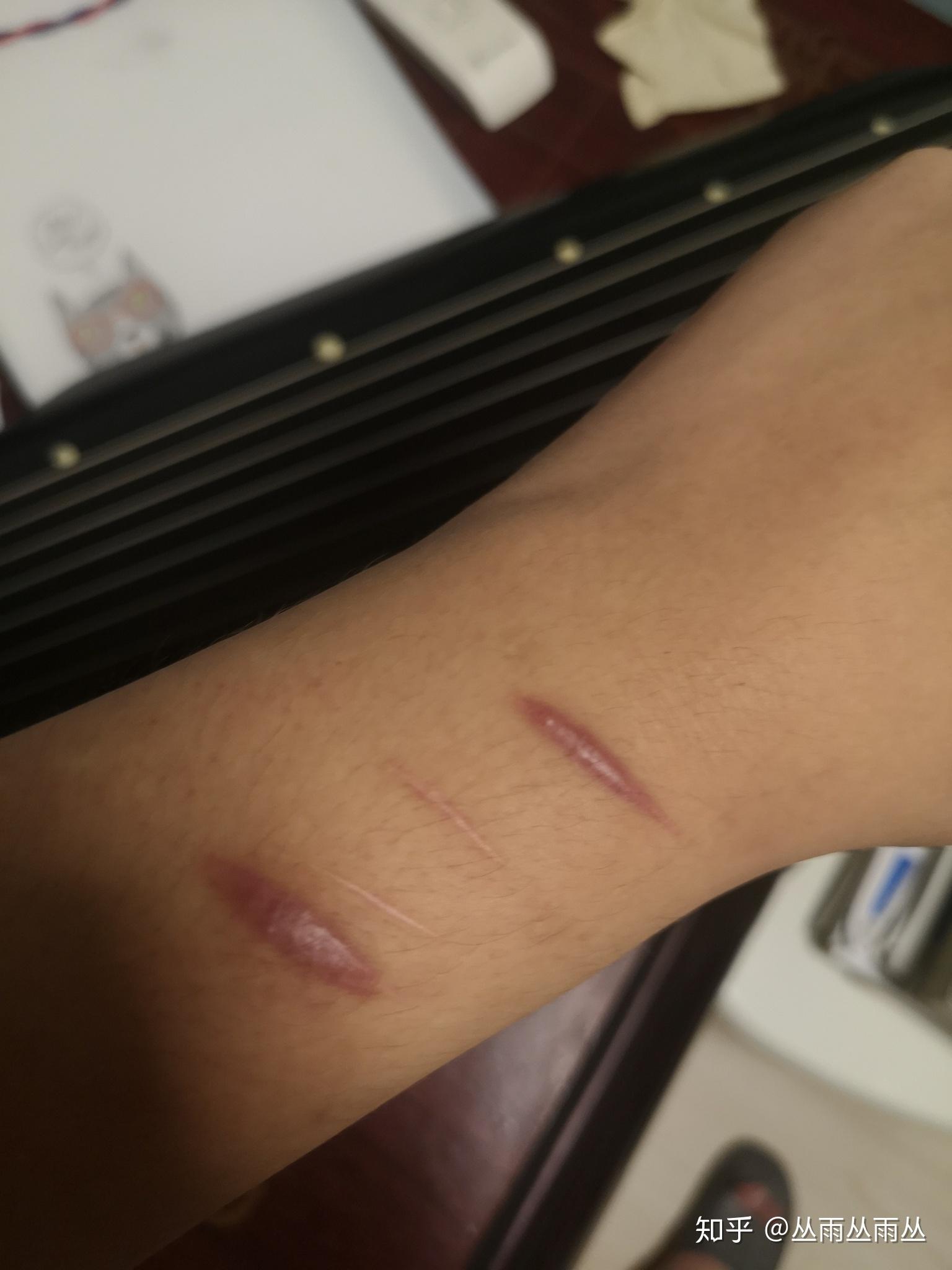 对于一个割腕过的人,未来如何向别人解释这道疤的由来? 