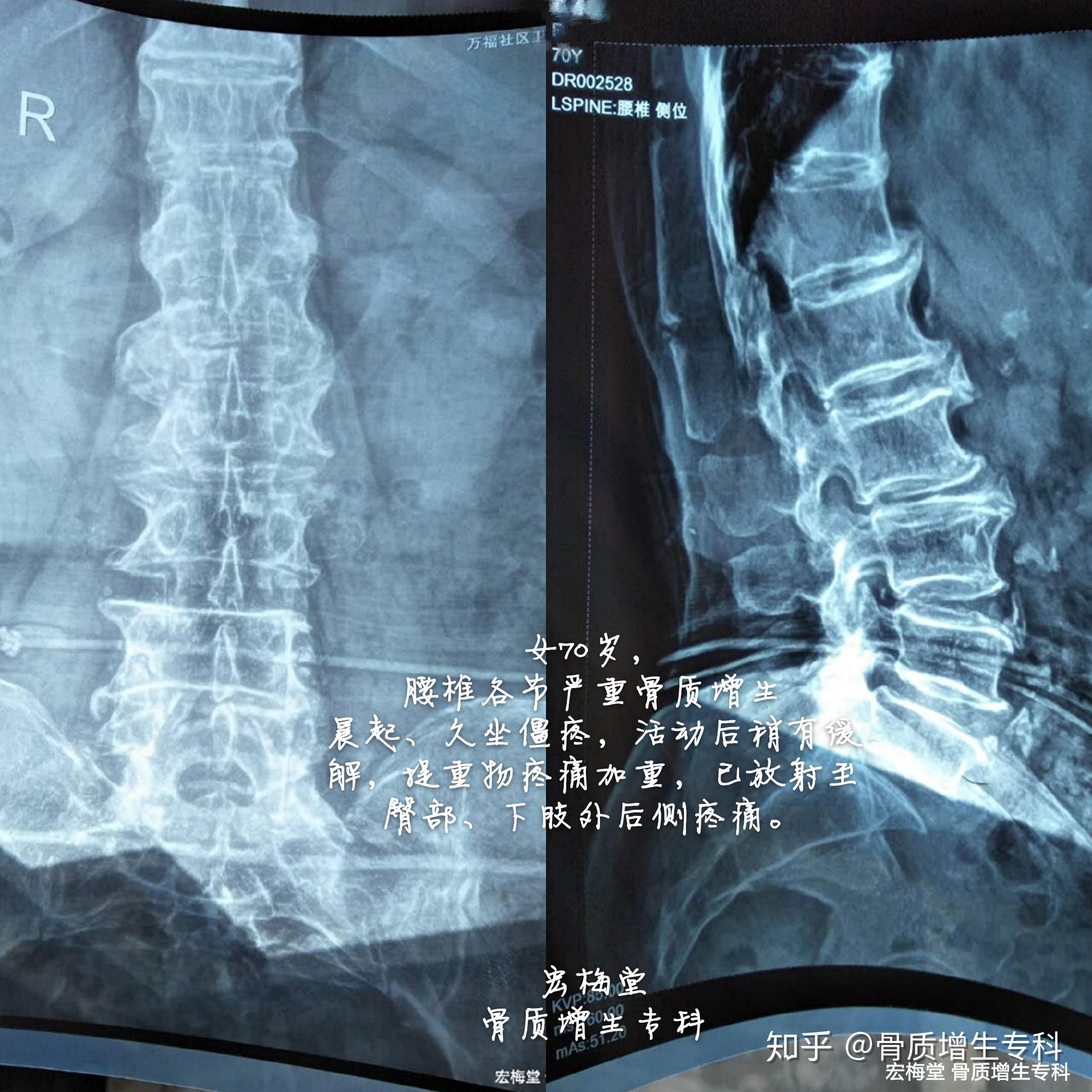 老妈得了腰脊椎骨质增生医生说治不治都可以