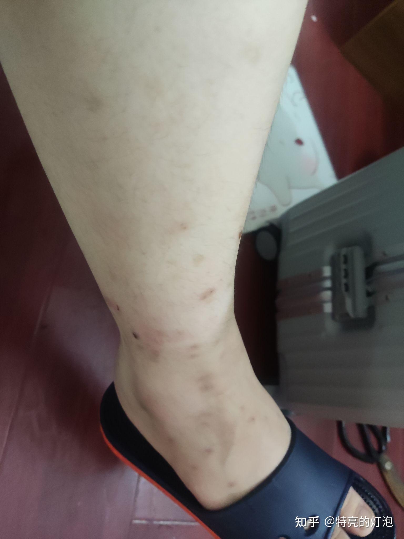 丘疹性荨麻疹留下的疤痕怎么去除? - 知乎