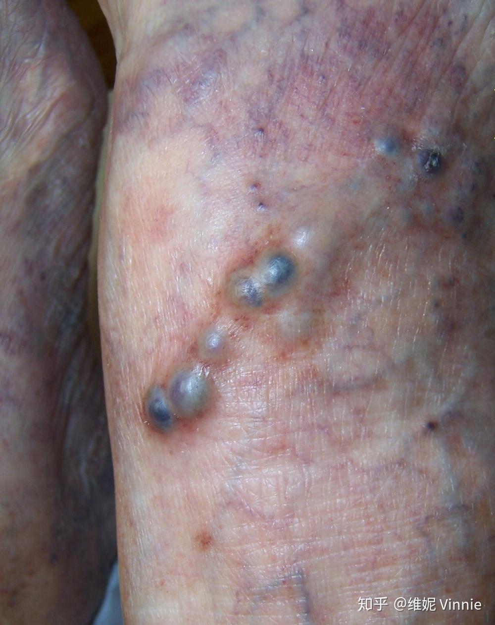 下肢浅静脉血栓是怎么回事?人们说的都很严重,有那么可怕吗?