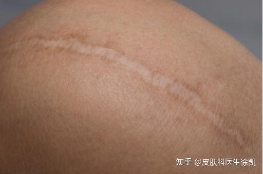 擦伤后疤痕增生多久能恢复?擦伤疤痕增生需要恢复多长时间? - 知乎