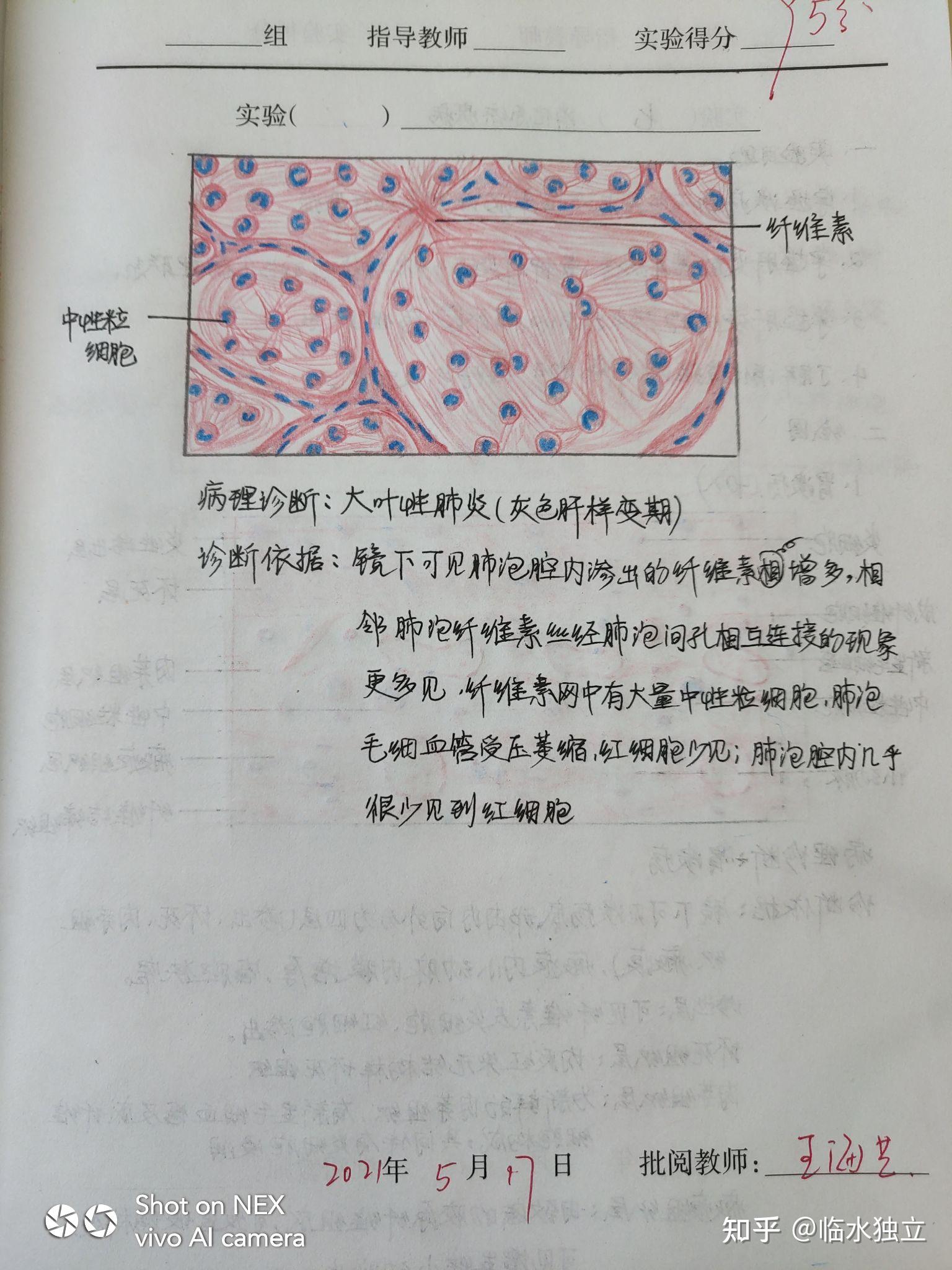 病理学红蓝铅笔图非毒性甲状腺肿