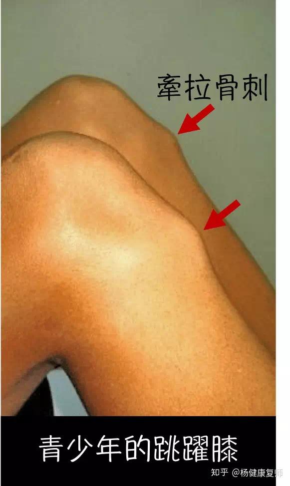 膝关节弯曲120°的图片图片