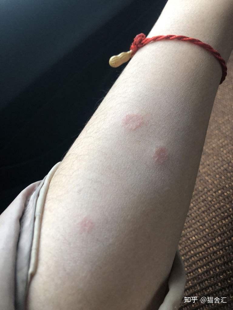 猫咪得了猫藓需要隔离吗?它总是爬床上,请问需不需要把它关起来.