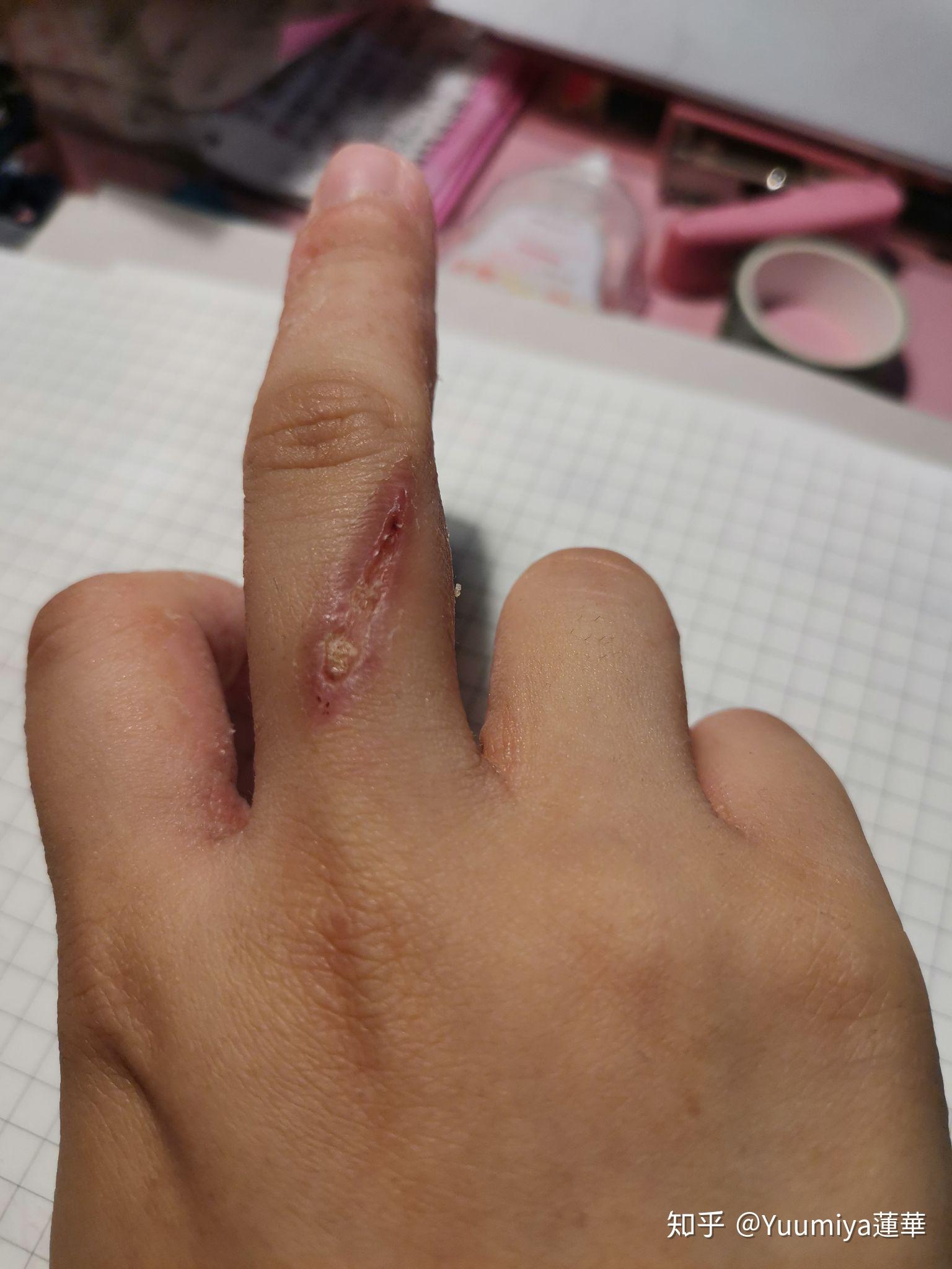 被电烙铁烫伤是一种什么样的体验怎么处理不易留疤