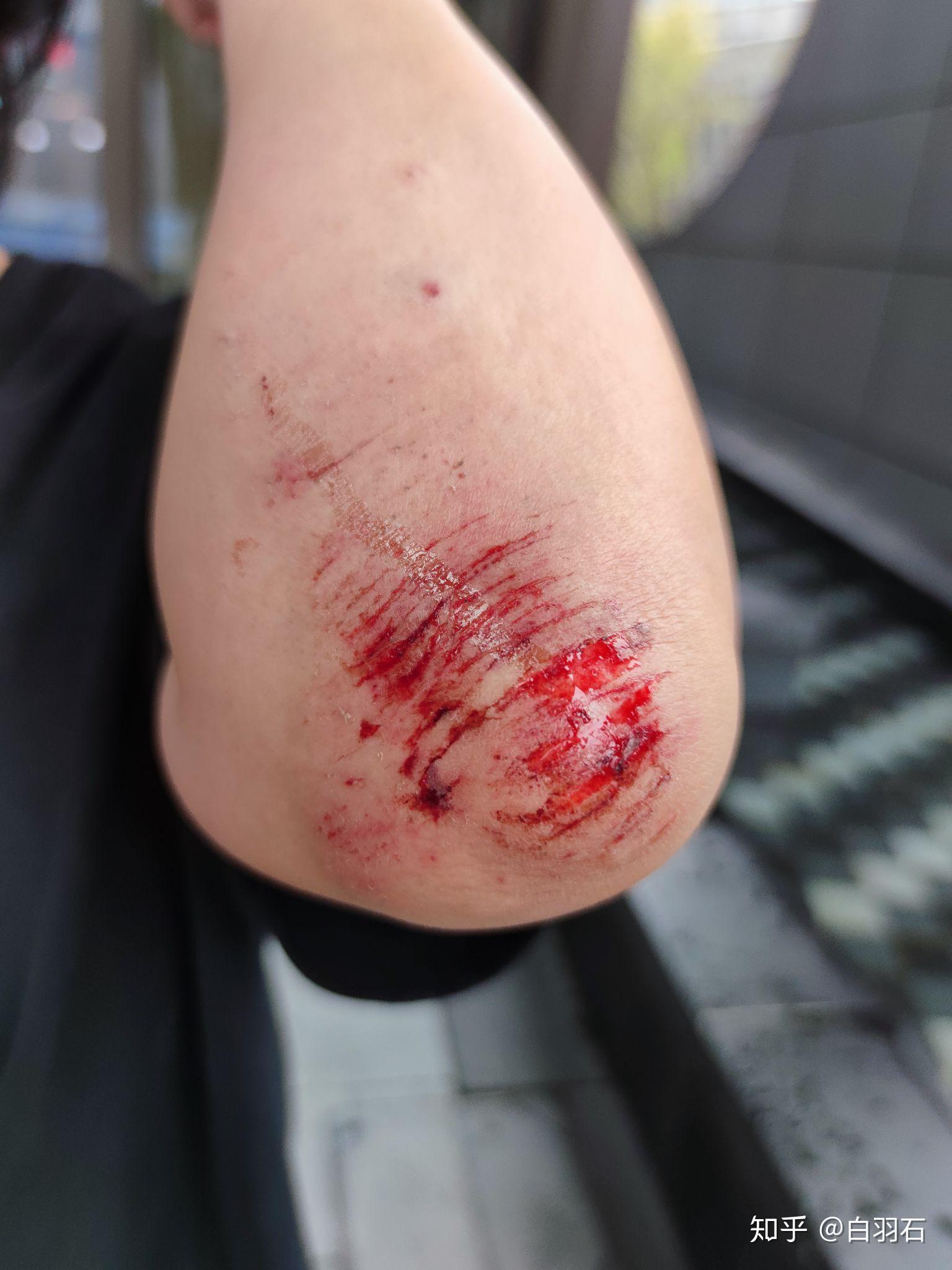 皮肤创伤擦伤的正确治疗方法是什么?