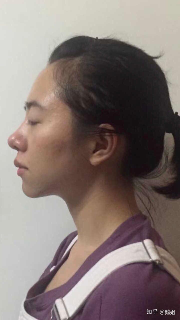 请问如何拯救凸嘴下巴后缩星人? - 知乎