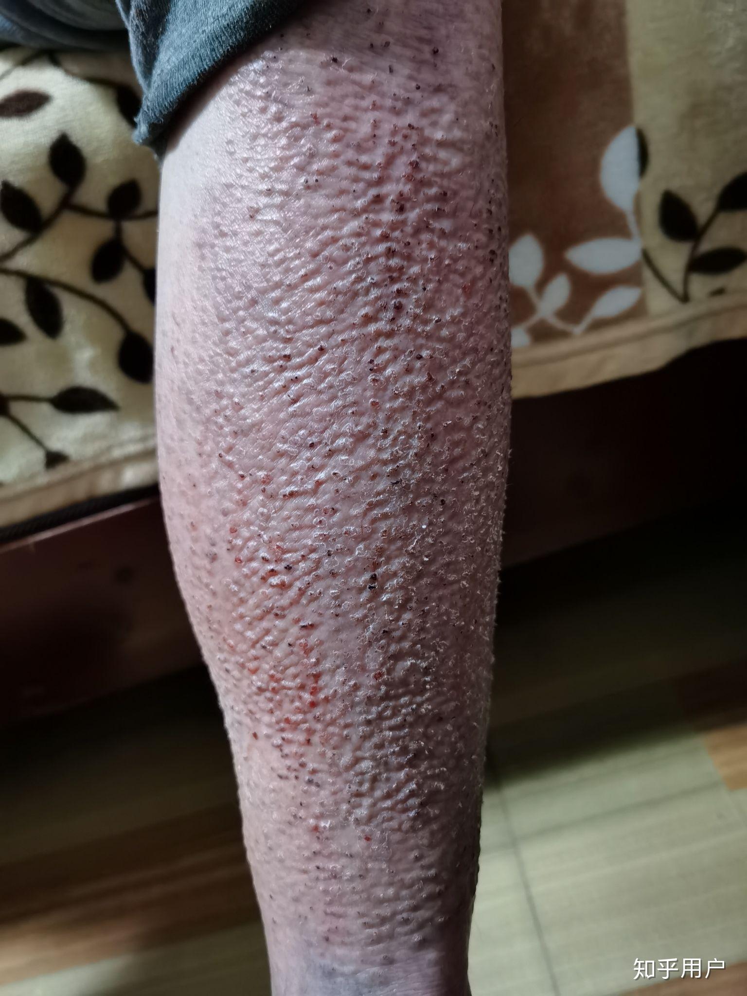 求科普核辐射损伤图片,如表面沾染伤,外照射损伤,皮肤辐射损伤,放射