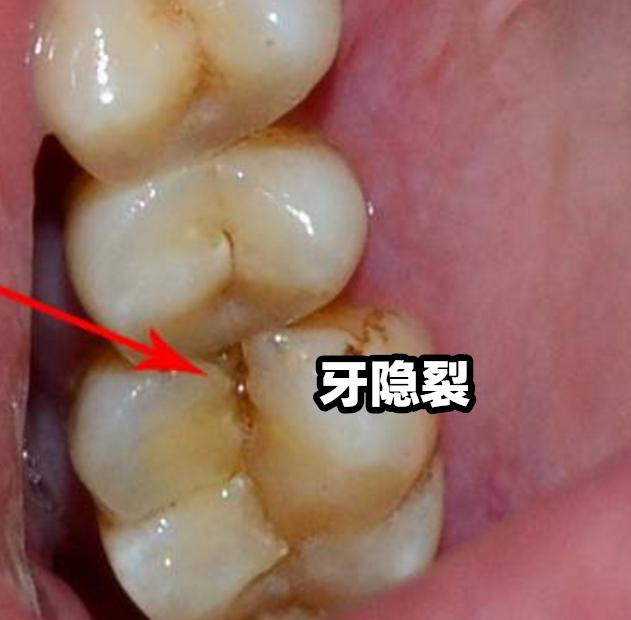 牙隱裂千萬不要等到絕境才去就醫不然就晚了