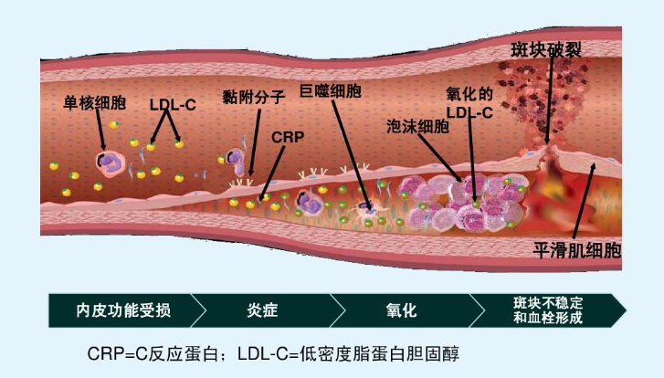 动脉粥样硬化到底是怎么回事?看完你就懂了! - 知乎