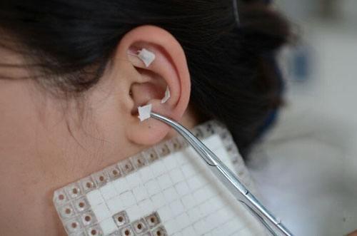 耳朵上压个豆就能治痤疮青春痘