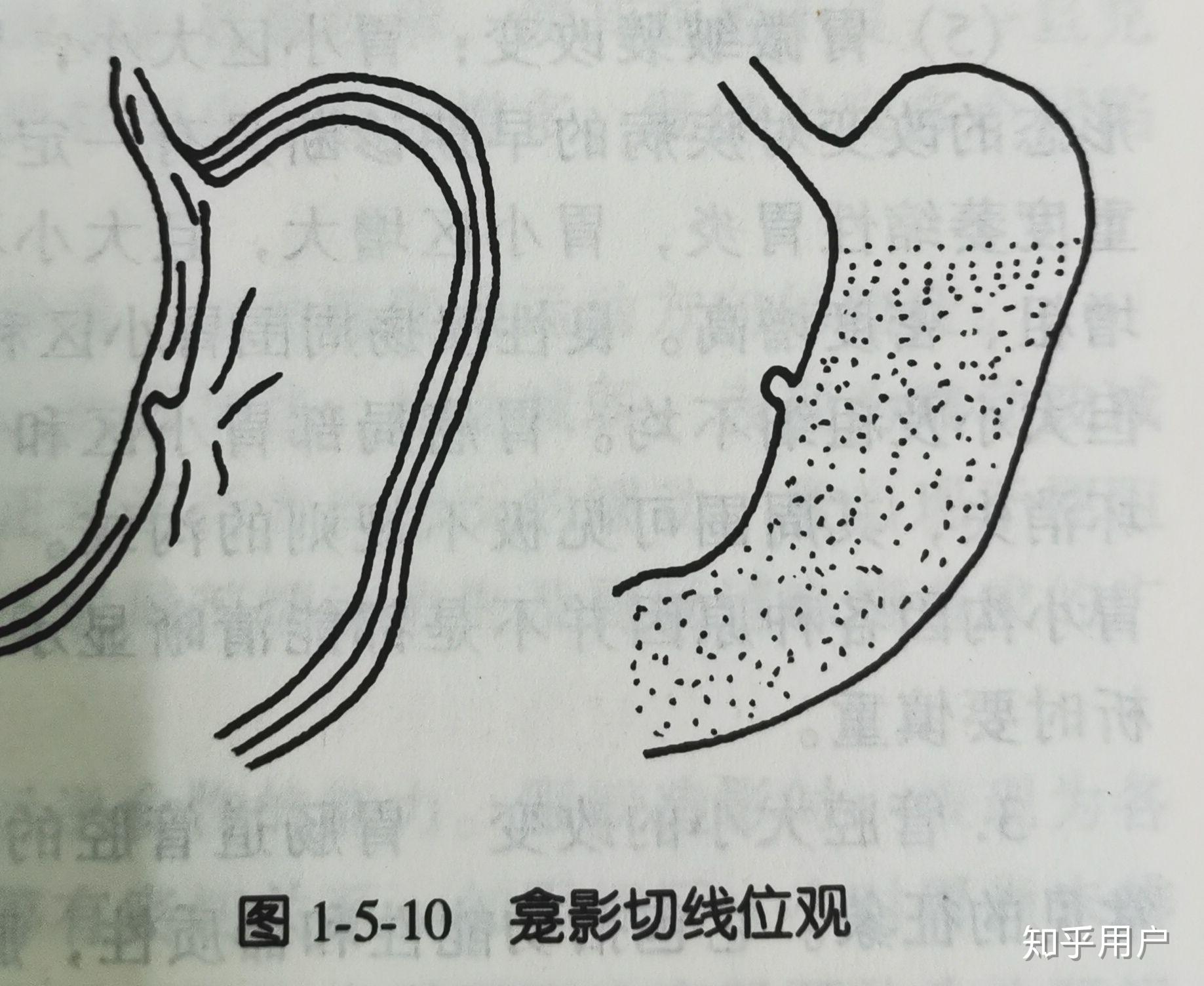 恶性龛影和充盈缺损都是向内凹陷的,那它们怎么区别呢?